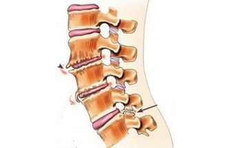 spondylartrossia bizkarreko minaren kausak bezala