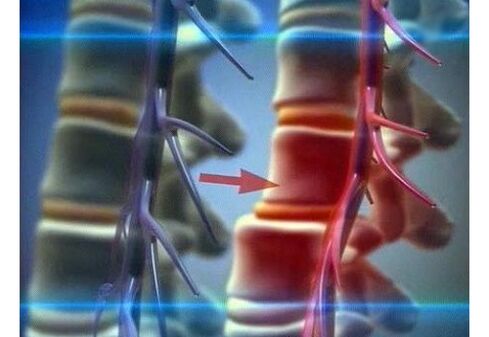 Nerbio-amaieraren konpresioa lumbar-osteokondrosian