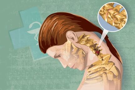 osteokondrosiaren sintoma erreflexuak