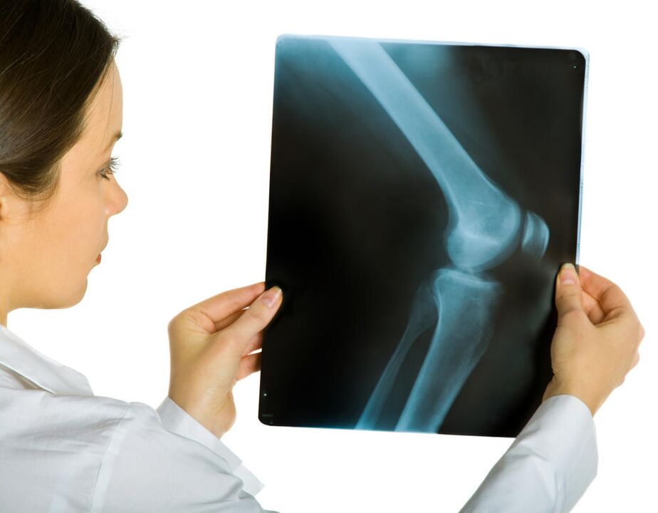 Belauneko artikulazioko X izpiek artrosi deformatzailearen presentzia agerian utziko dute